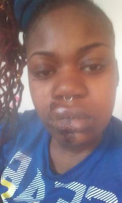 Diamond Rust's face after being roughed up by a Metro transit police officer in February 2018 (Courtesy of Eliot Williamson)