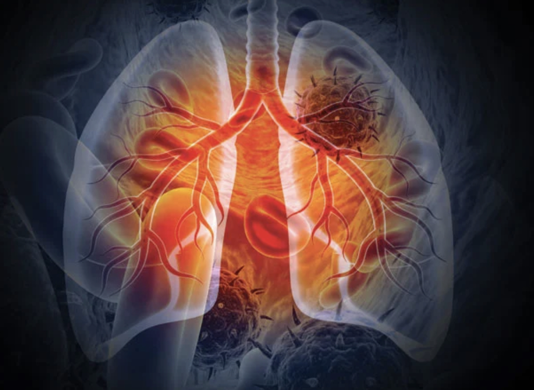 In the American Lung Association’s latest "State of Lung Cancer" report, attention is focused on the stark racial inequalities in lung cancer rates, treatment access, and outcomes within Black communities, including in D.C., Maryland and Virginia. (Courtesy photo)